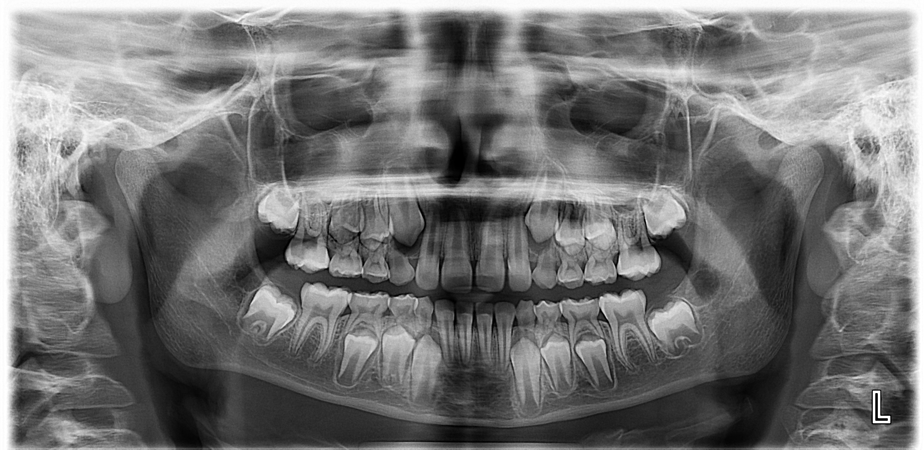 10 Babys Teeth Xray Tips For Healthy Smiles