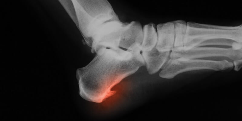 10+ Bone Spur Treatments To Ease Molar Tooth Pain