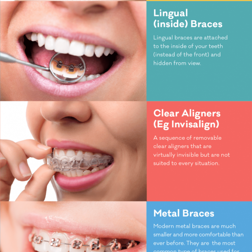 10+ Braces Options To Straighten Teeth Fast
