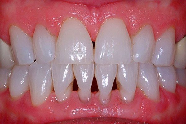 10+ Brown Spots Between Teeth Fixes Guaranteed