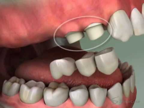 10 Cantilever Bridge Tooth Fixes