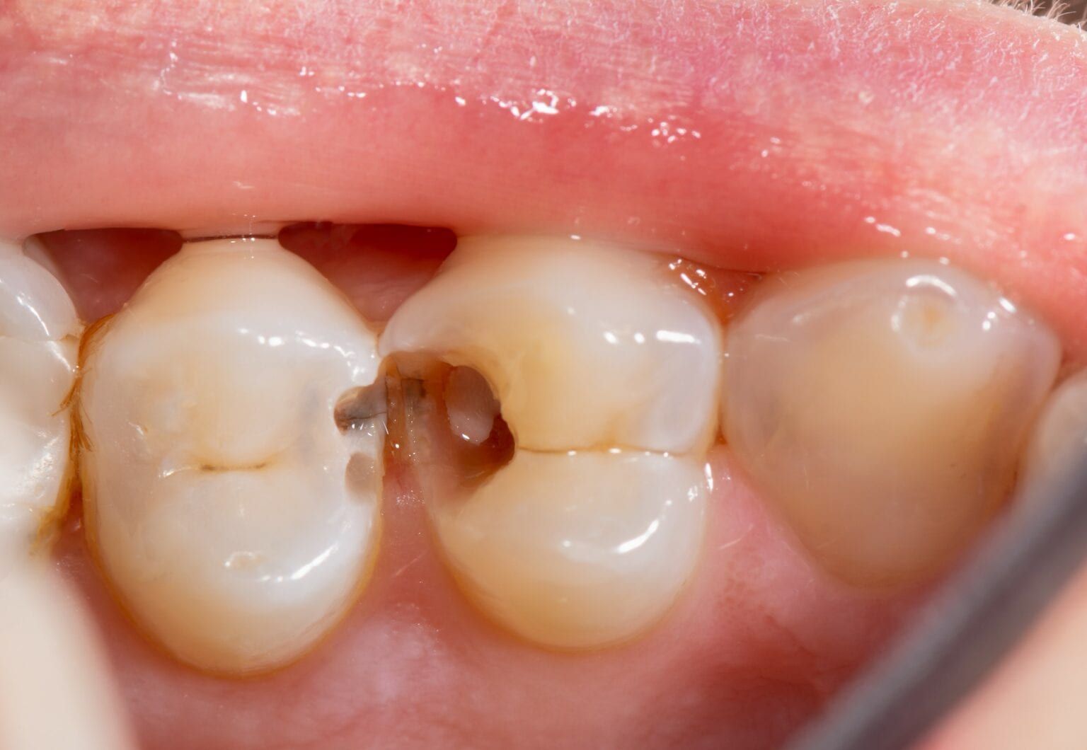 10 Class 2 Dental Caries Tips For Easier Treatment 10 Class 2 Dental Caries Tips For Easier Treatment