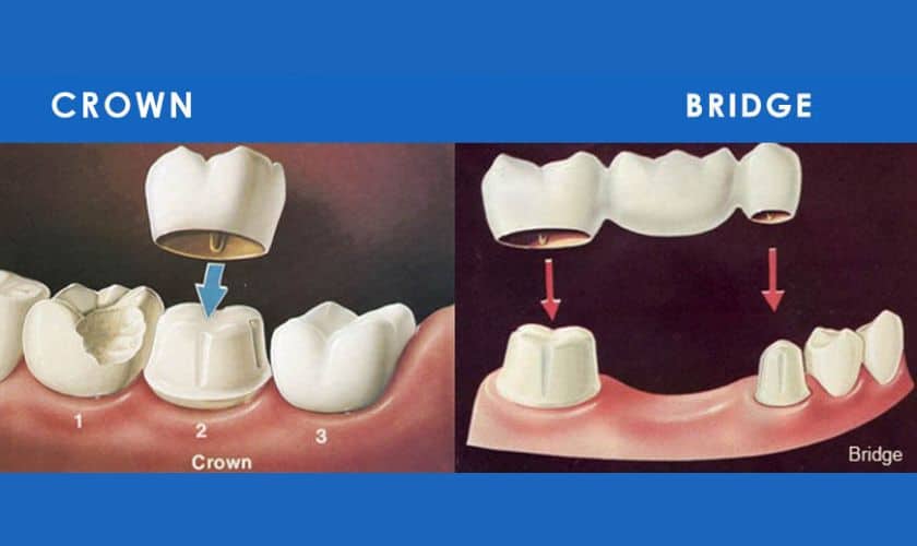 10+ Crown Options For Perfect Smile