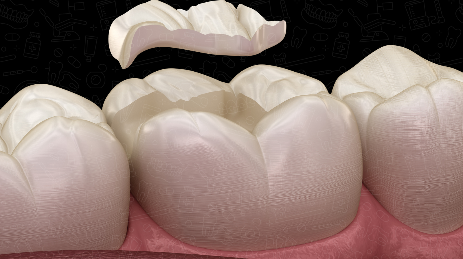 10+ Dental Bridge Crowns Secrets For Long Lasting Teeth