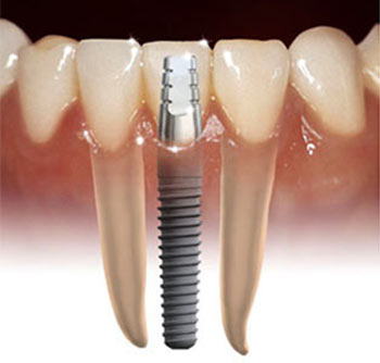 10+ Dental Implant Secrets For Natural Look