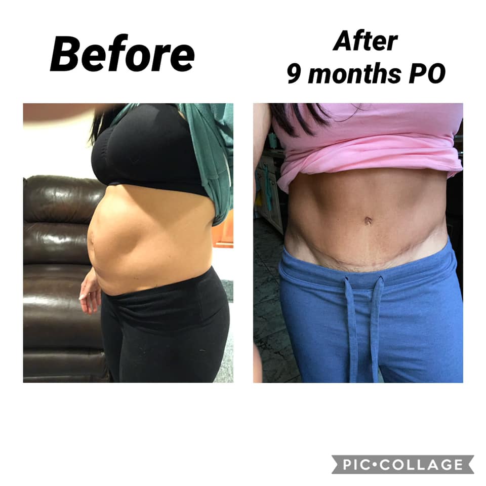 10 Diastasis Recti Surgery Fixes 10 Diastasis Recti Surgery Fixes