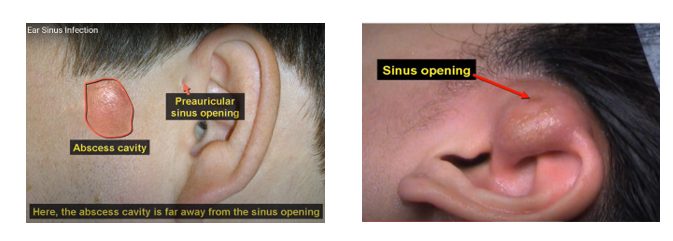 10+ Ear Sinus Infection Tips For Fast Recovery