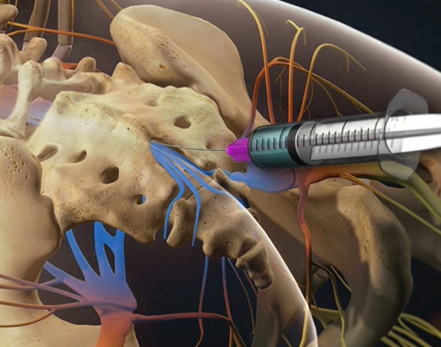 10+ Esi Injection Remedies For Lasting Pain Relief