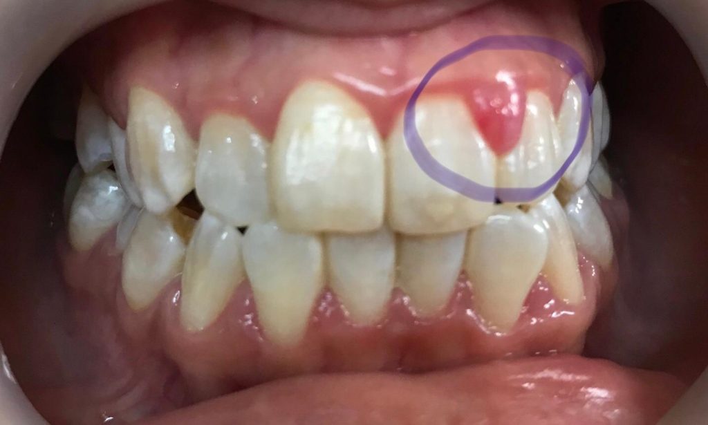 10 Gum Swelling Fixes