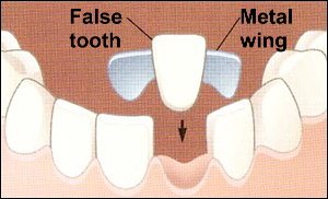 10 Maryland Tooth Bridge Tips For Smoother Smile