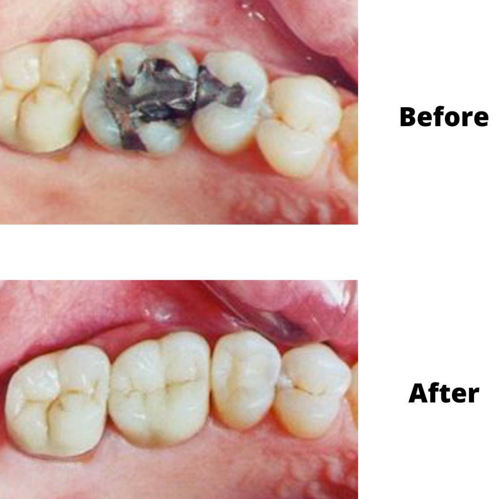 10 Teeth Filling Near Me Options For Quick Relief