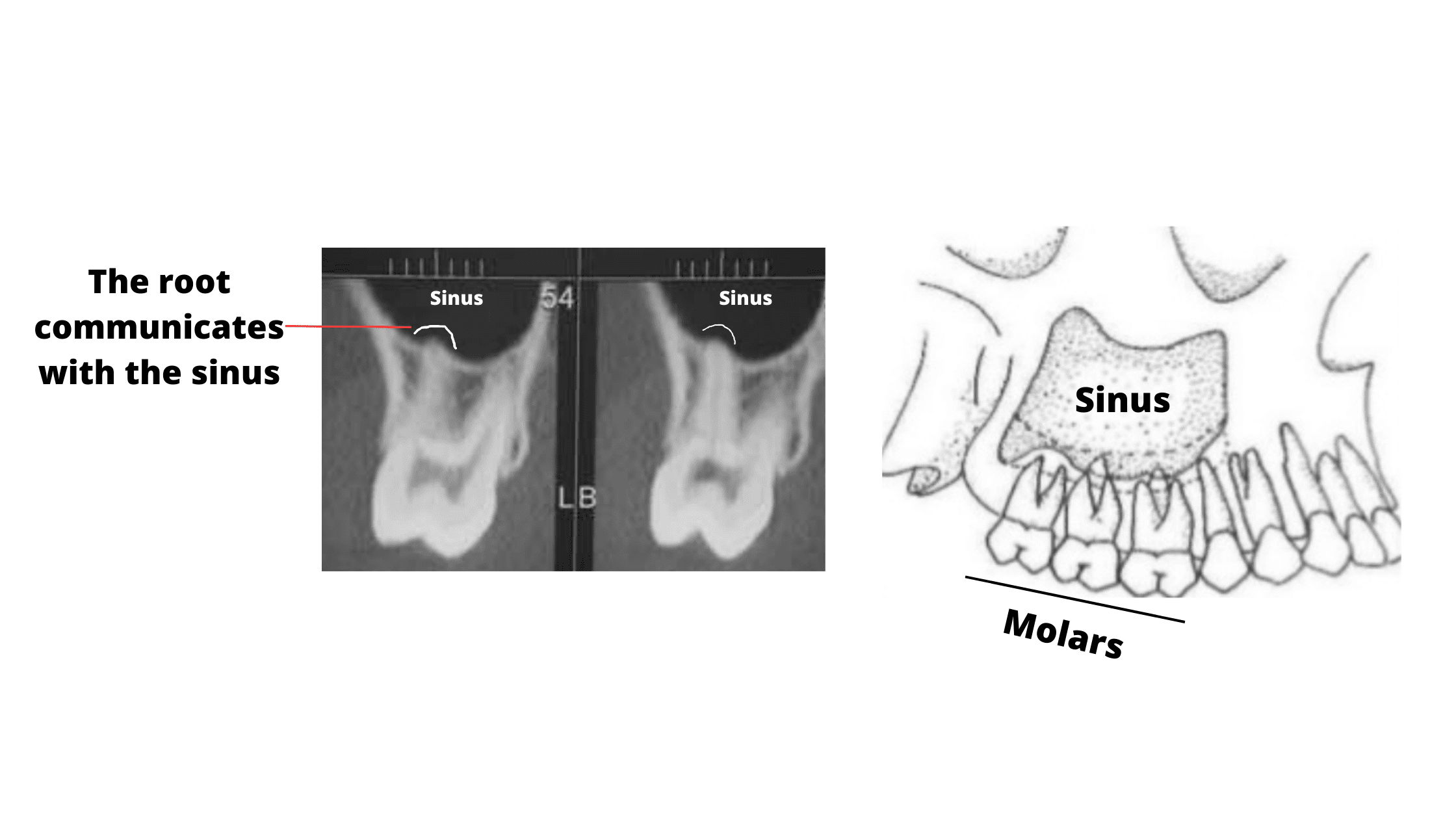 10 Tooth Pulled Tips To Reduce Pain