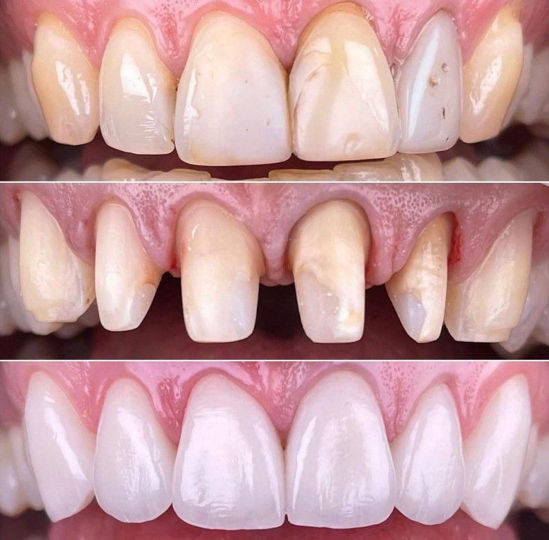 10+ Ways To Whiten A Crown Naturally