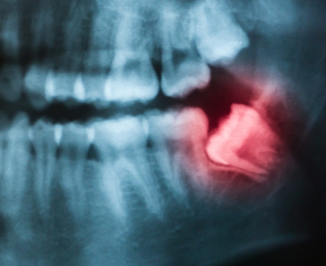 10+ Wisdom Teeth Removals Near Me For Less Pain 10+ Wisdom Teeth Removals Near Me For Less Pain