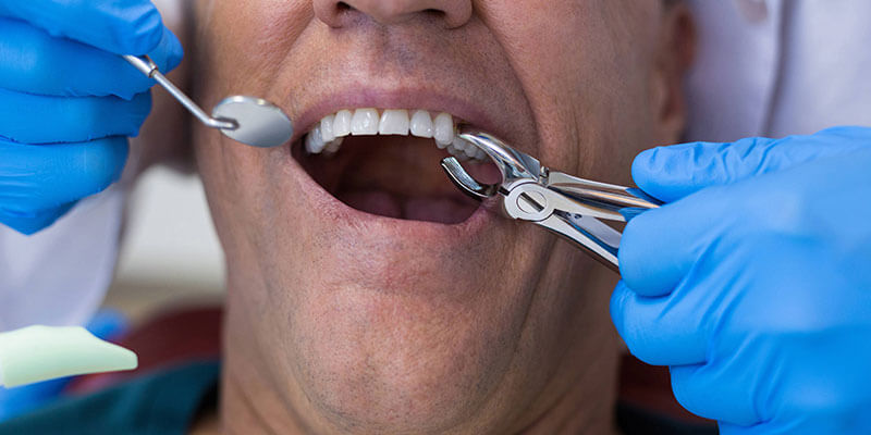 10 Wisdom Tooth Tips For Faster Healing