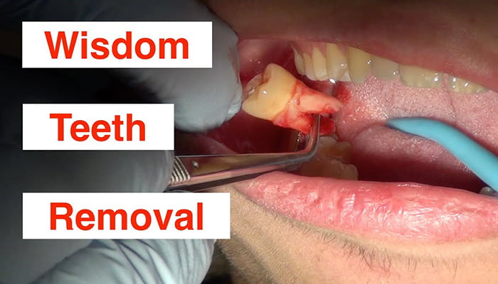 10 Wisdom Tooth Tips For Less Pain