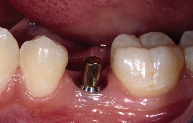 12+ Abutment Options For Perfect Dental Implant Fits