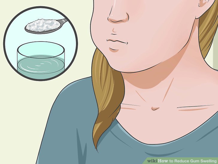 12+ Braces Tips To Reduce Gum Swelling