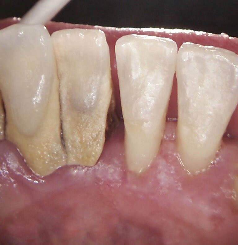 12+ Calculus Removal Tips For Healthier Teeth