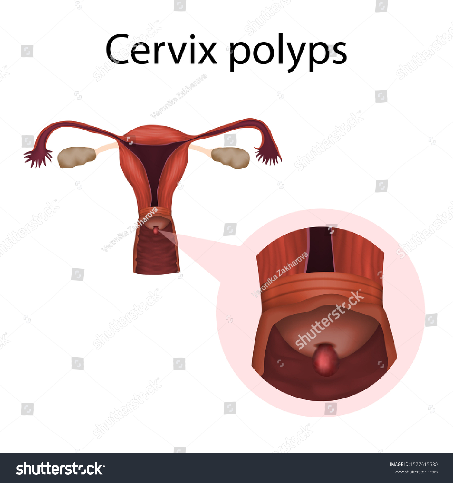 12 Cervix Polyps Images For Accurate Diagnosis