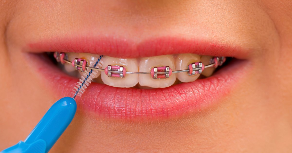 12 Colores Para Brackets Que Mejoran La Visibilidad