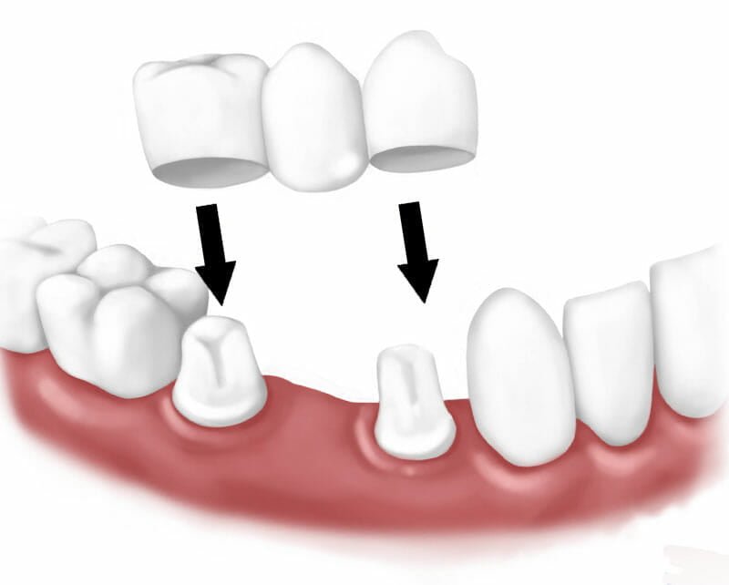 12+ Dental Bridge Options That Save You Money