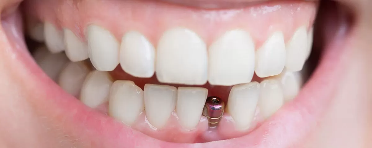 12 Front Teeth Dental Implants For Perfect Smile