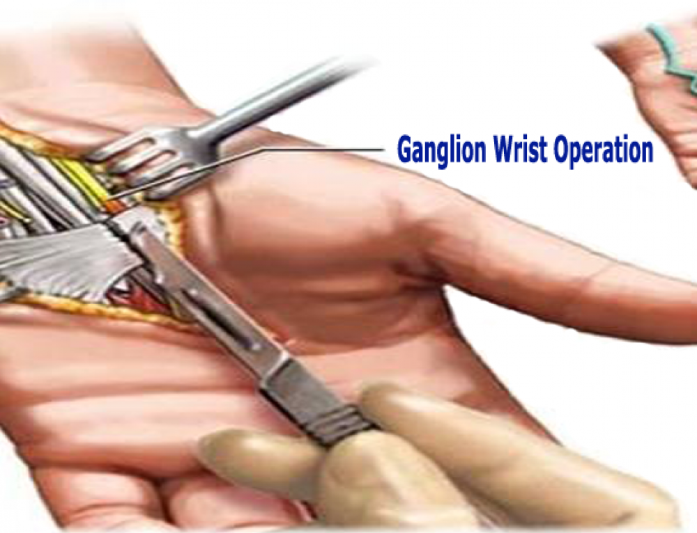 12+ Ganglion Cyst Treatments To Reduce Swelling