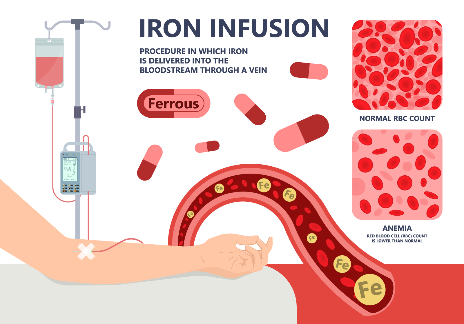 12+ Iron Deficiency Solutions With Levothyroxine
