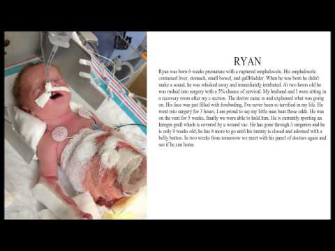 12+ Omphalocele Pictures For Parental Understanding 12+ Omphalocele Pictures For Parental Understanding