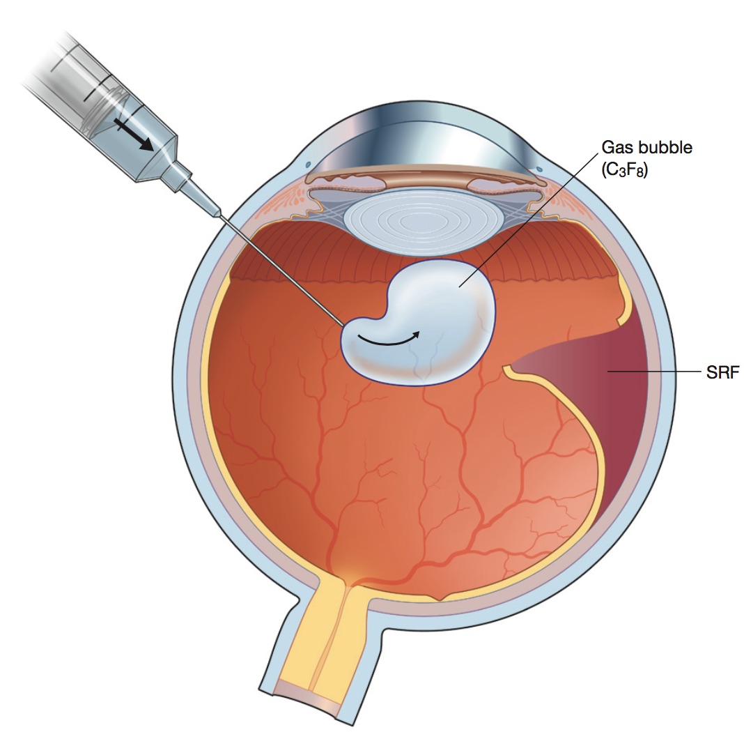 12+ Retina Detachment Tips For Faster Healing