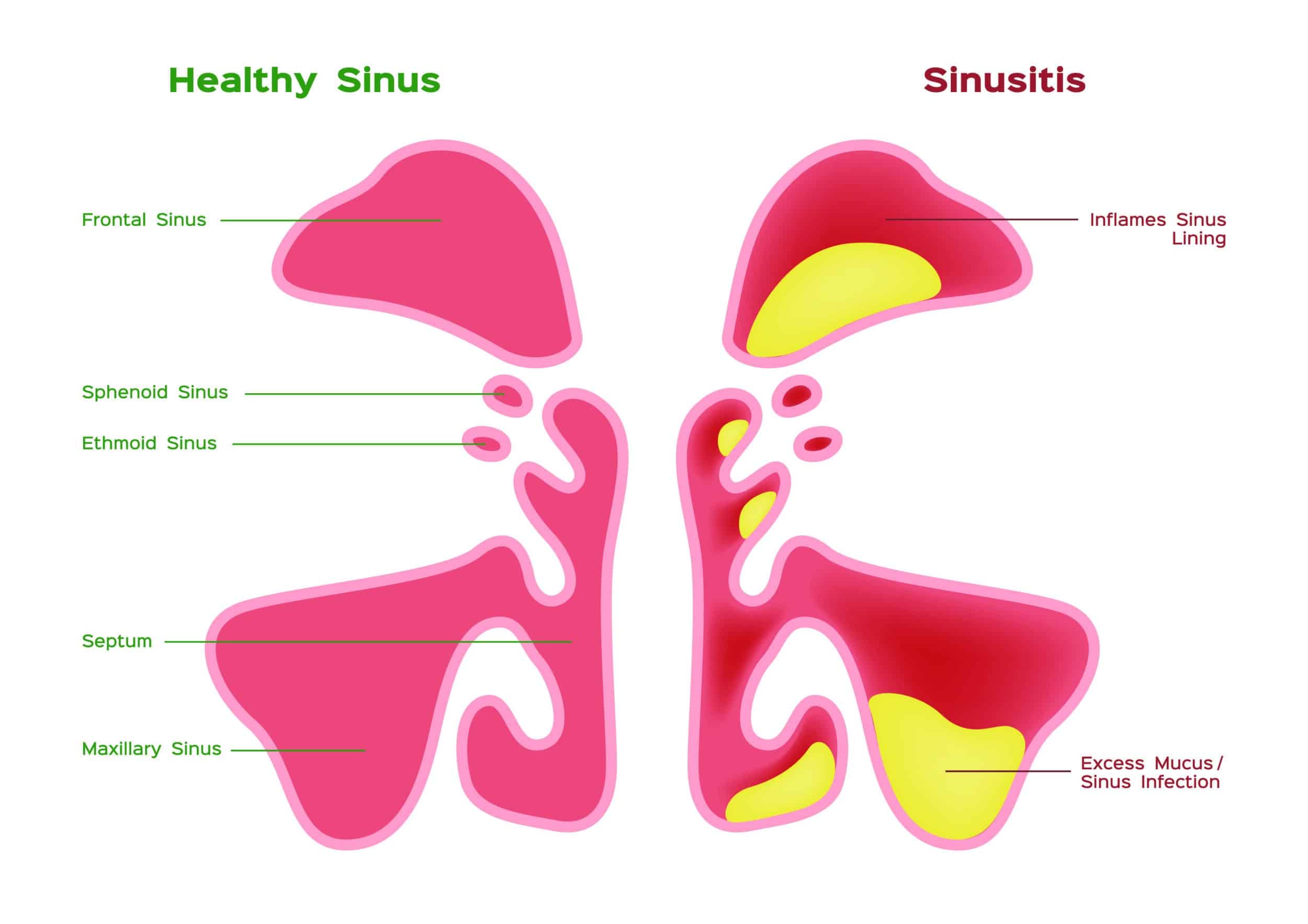 12+ Sinus Tips To End Chronic Discomfort