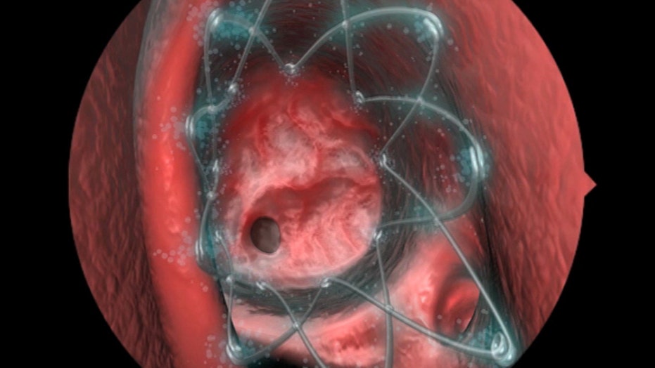12+ Stent Pain Solutions To Ease Discomfort