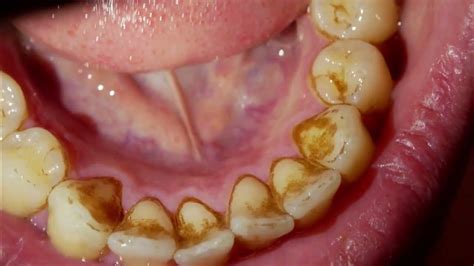 12 Tartar Prevention Tips For Healthier Smiles