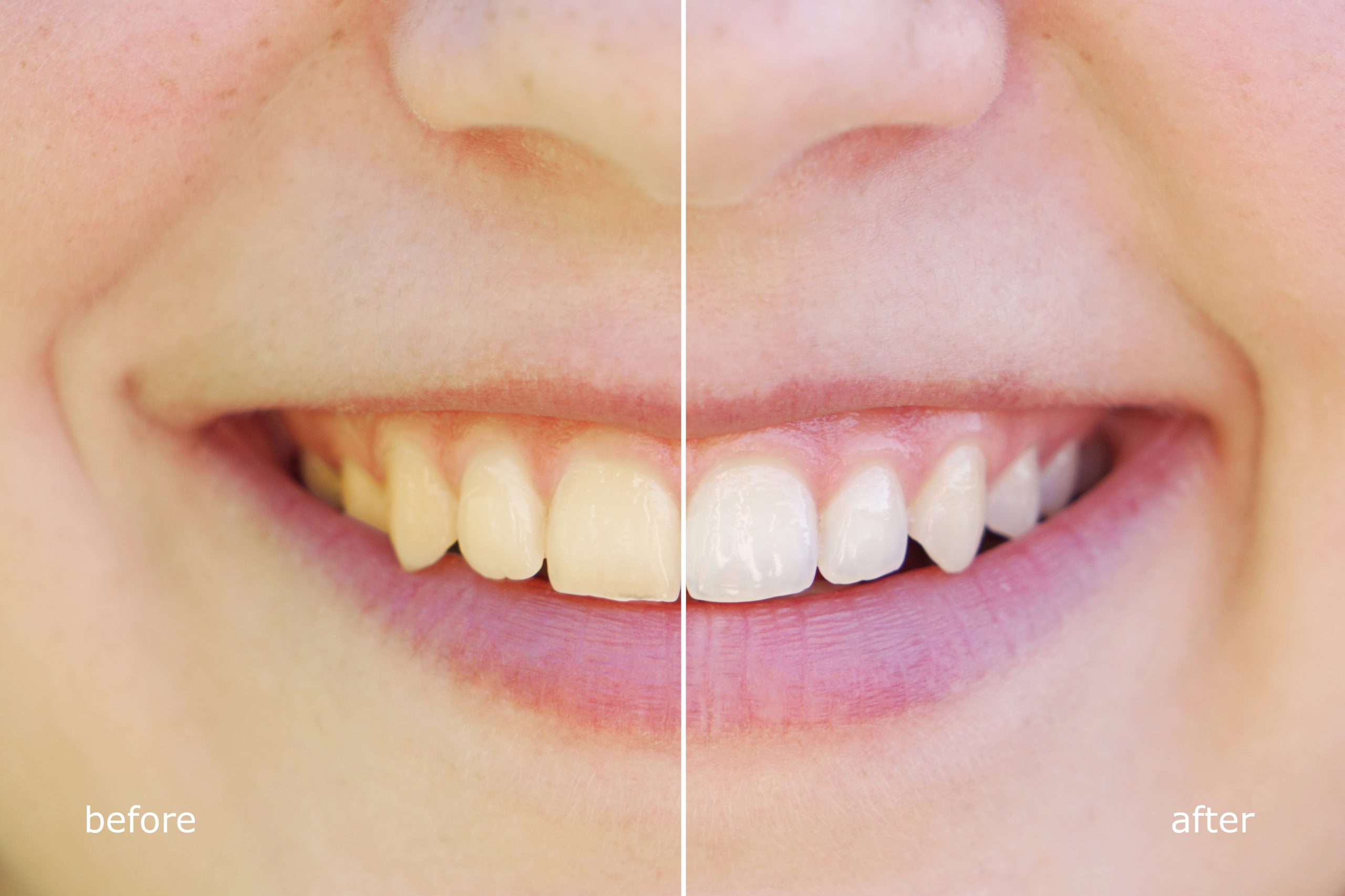 12+ Teeth Stains Solutions With Braces