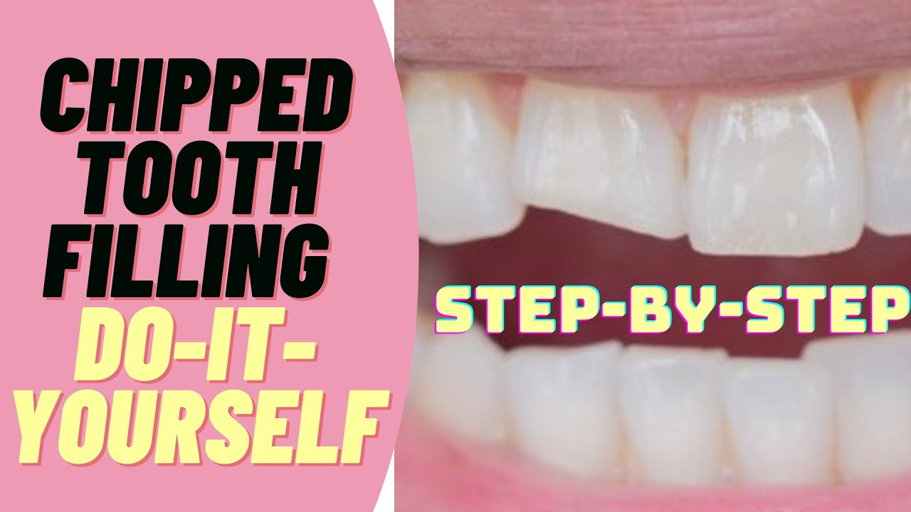 12+ Tooth Filling Fixes Guaranteed