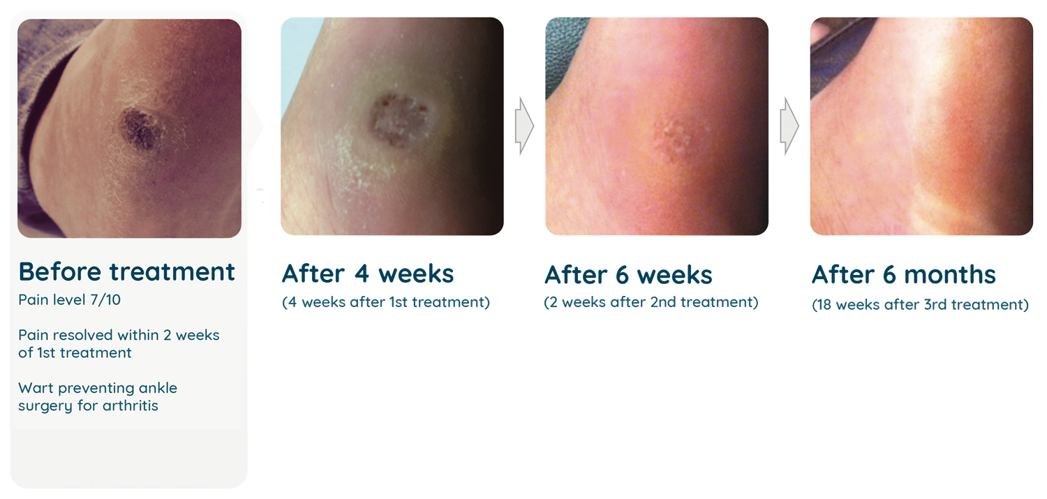 12+ Wart Biopsy Secrets For Effective Treatment