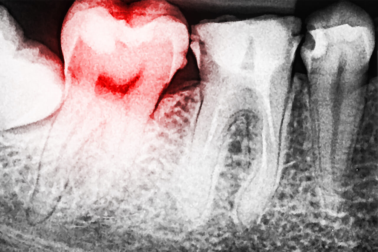 12+ Ways To Fix Exposed Tooth Root For Pain Free Smile