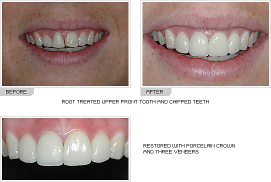 12+ Ways To Reduce Crown Of Teeth Cost