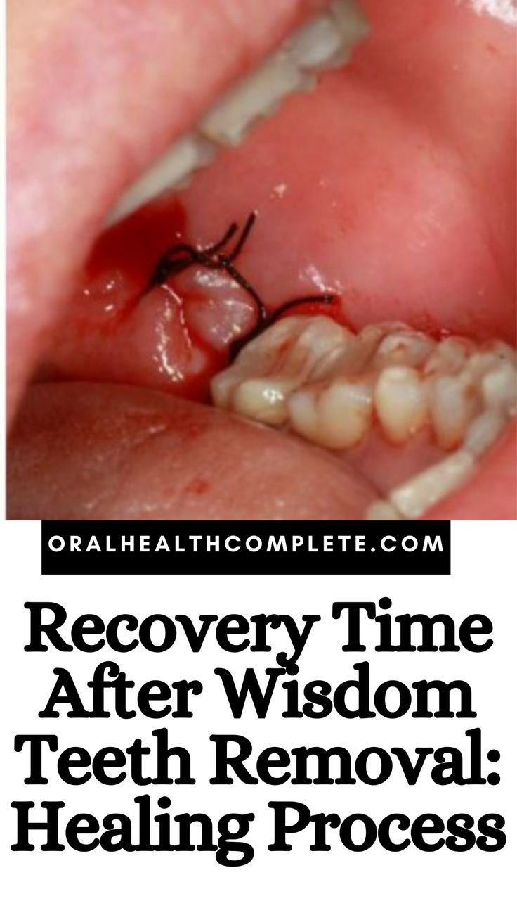 12+ Wisdom Teeth Secrets For Safe Recovery