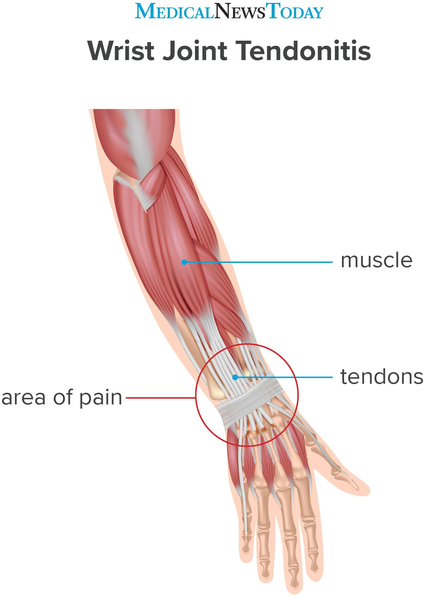12+ Wrist Tendonitis Stretches To Reduce Pain