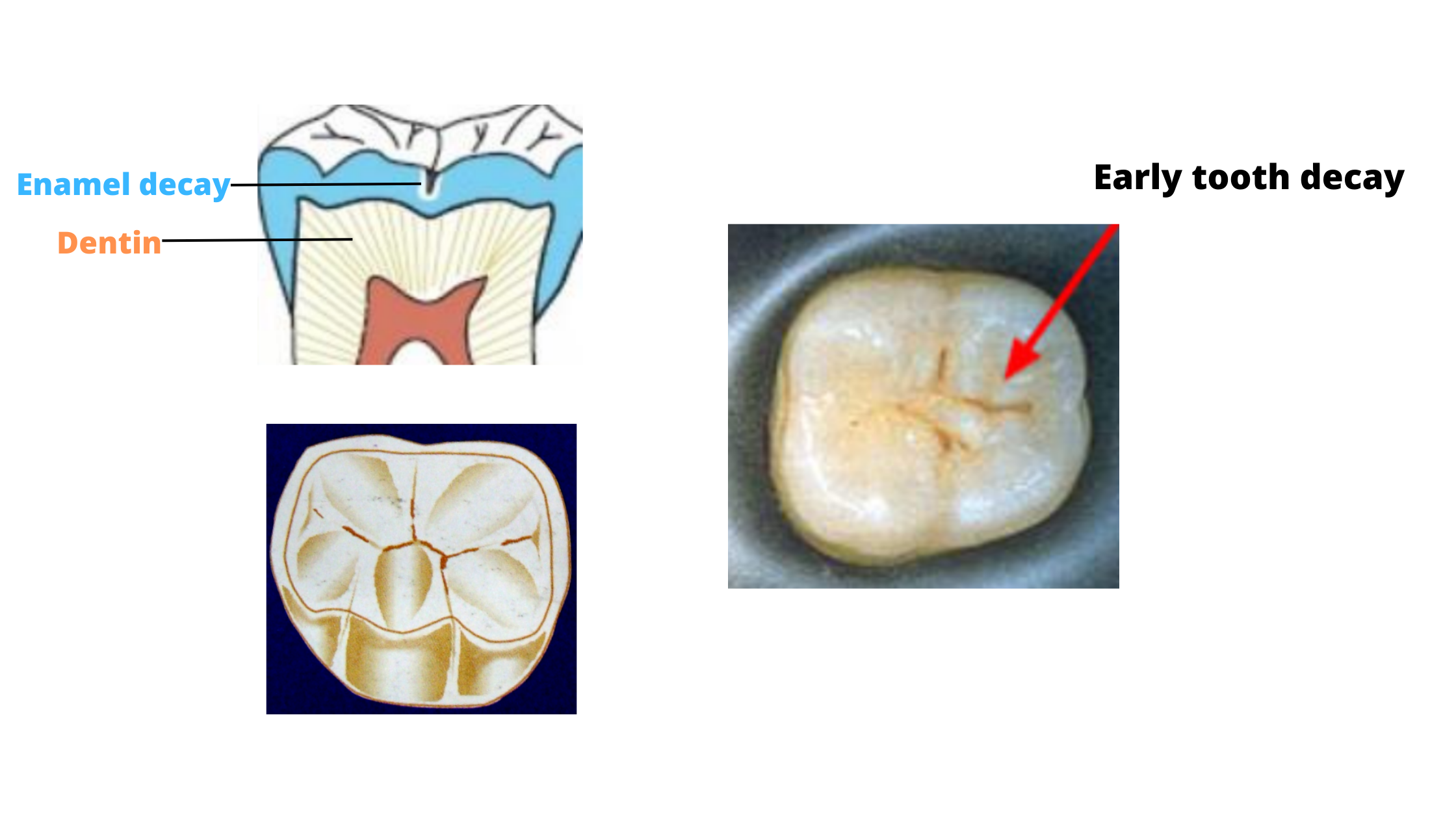 12+ Xray Secrets For Identifying Tooth Decay Early