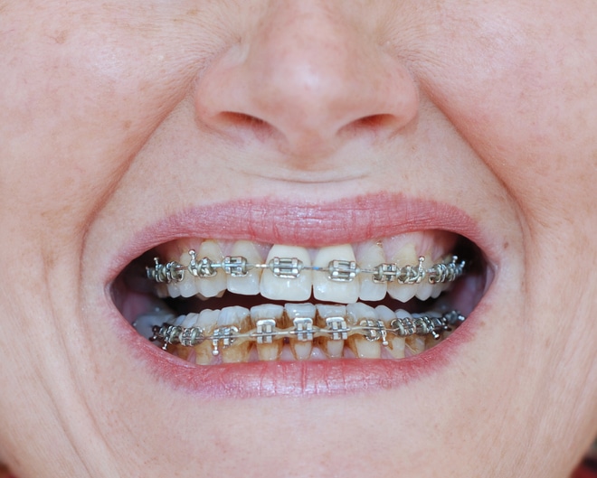 7 Teeth Staining Fixes After Braces