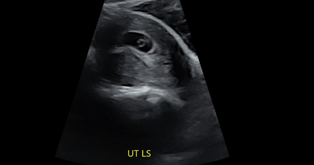 7 Week Ultrasound 3D: See Your Baby's Face