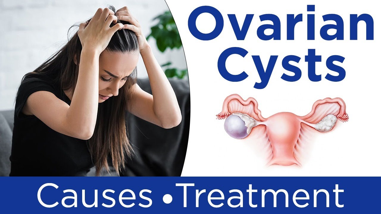 8 Ovarian Cyst Symptoms To Know Fast