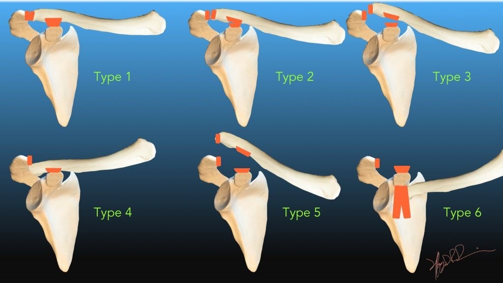 Ac Joint Separation Pt: Reduce Pain & Recover Quickly