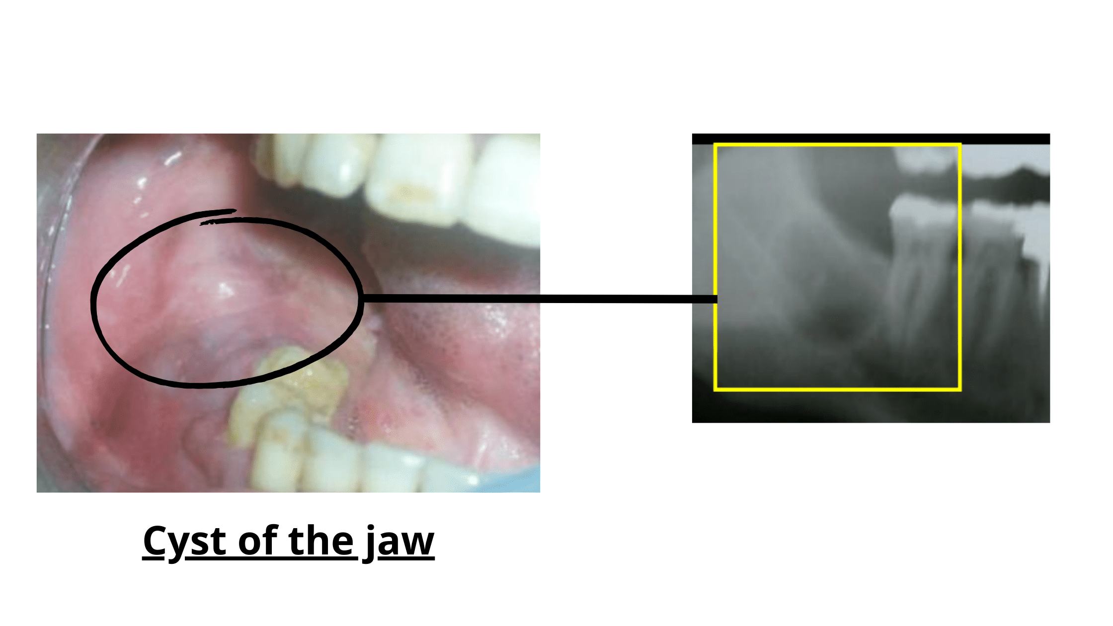 After Wisdom Tooth Surgery Pain After Wisdom Tooth Surgery Pain