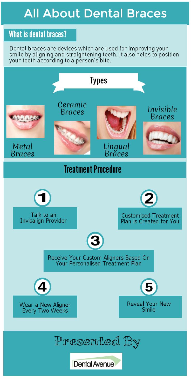 Alternative For Braces Dental
