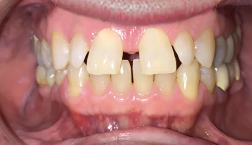 Aspen Dental Aligners Aspen Dental Aligners