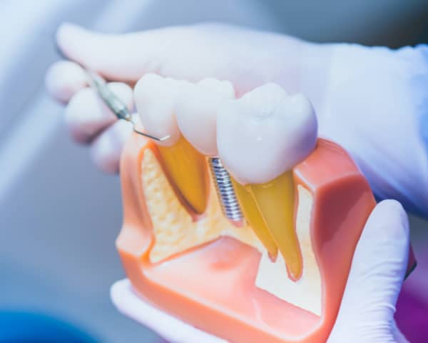 Aspen Dental Bensalem Pa: Affordable Smile Solutions
